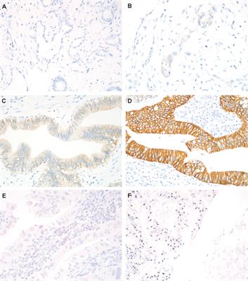 Expression of HER2 and Mismatch Repair Proteins in Surgically Resected Gallbladder Adenocarcinoma